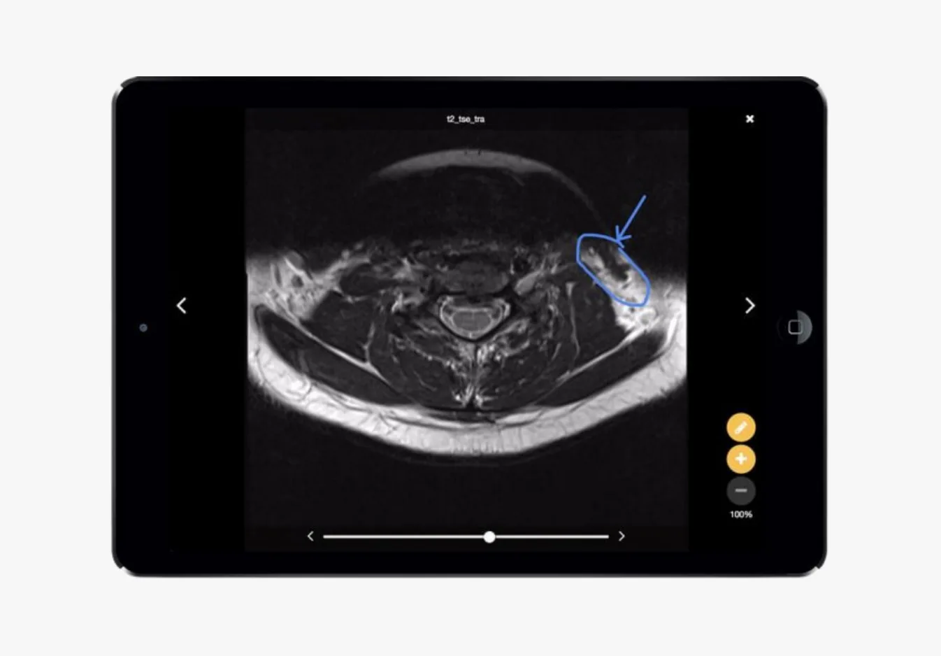 Medical imaging interface displaying an axial MRI cross-section of the abdomen with a blue annotation highlighting a specific anatomical structure or area of interest on the right side.